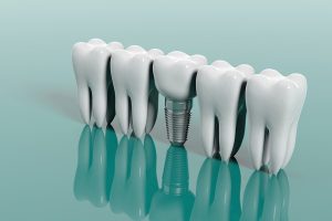 Dental Implants in One Day