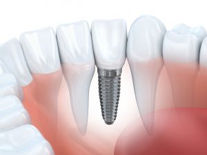Tooth human implant (done in 3d graphics)