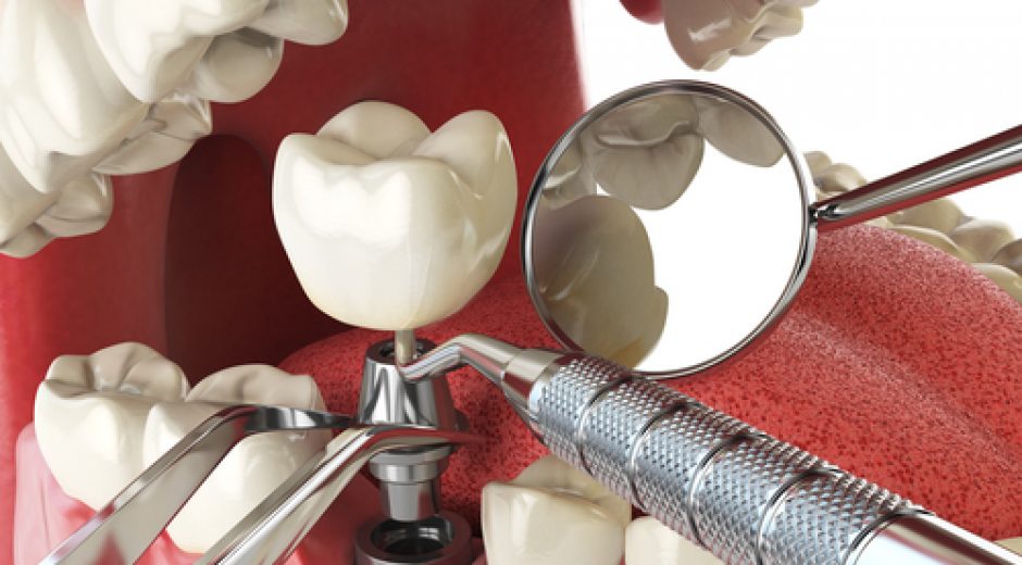 New Teeth In One Day Dental Clinics 
